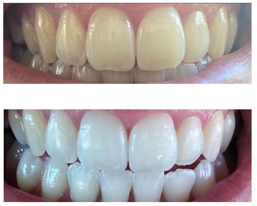 Avant après blanchiment Dental Glow