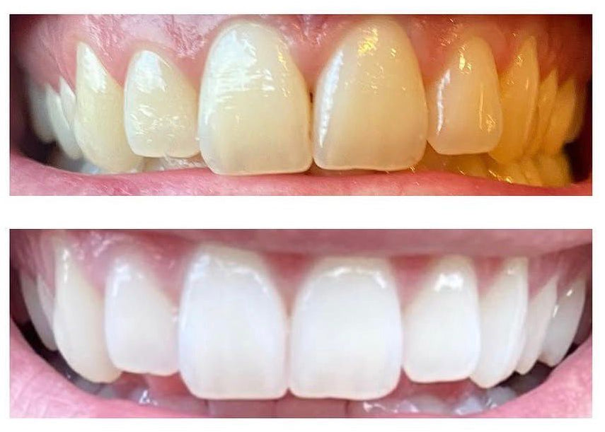 Avant après blanchiment Dental Glow