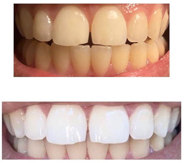 Avant après blanchiment Dental Glow