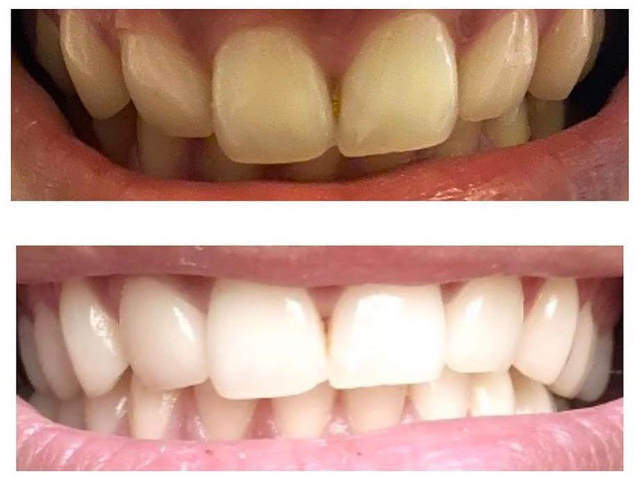 Avant après blanchiment Dental Glow